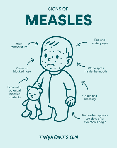 Measles – Spread, Treatment & Prevention